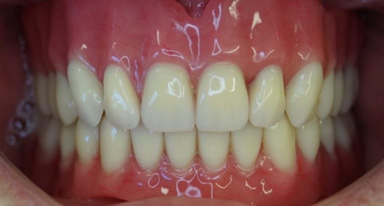 VorherNachherGalerie Zahnklinik Ungarn Bavaria Dental