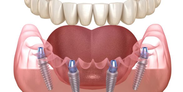 Darstellung zum Thema Mandibular prosthesis All on 4 system supported by implants. Medically accurate 3D illustration of human teeth and dentures concept bei Bavaria Dental Budapest