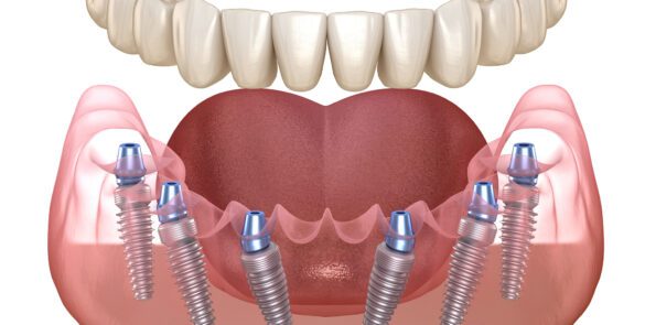 Darstellung zum Thema Mandibular prosthesis All on 6 system supported by implants. Medically accurate 3D illustration of human teeth and dentures concept bei Bavaria Dental Budapest