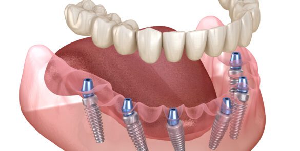 Darstellung zum Thema Mandibular prosthesis with gum All on 6 system supported by implants. Medically accurate 3D illustration of human teeth and dentures concept bei Bavaria Dental Budapest