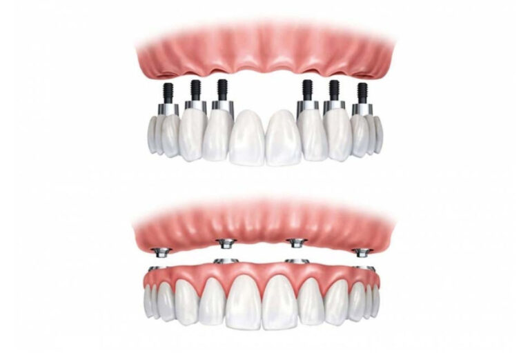 All-on-4 Zahnersatz in Budapest – fester Zahnersatz bei Zahnverlust
