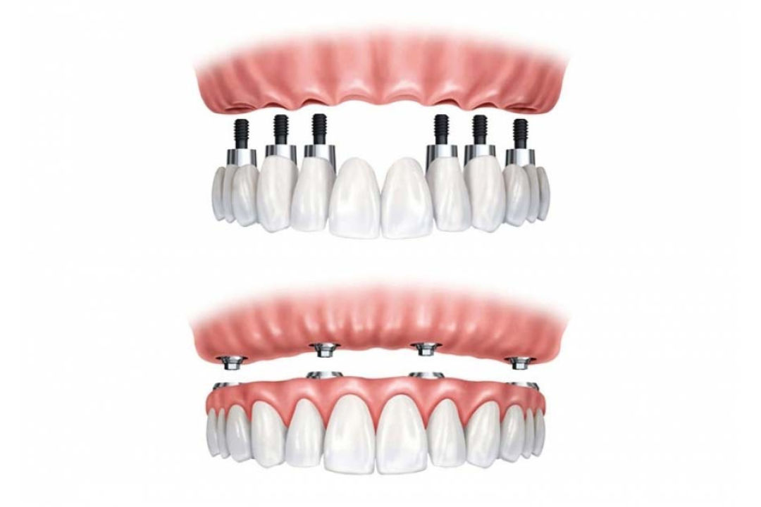 All-on-4 Zahnersatz in Budapest – fester Zahnersatz bei Zahnverlust