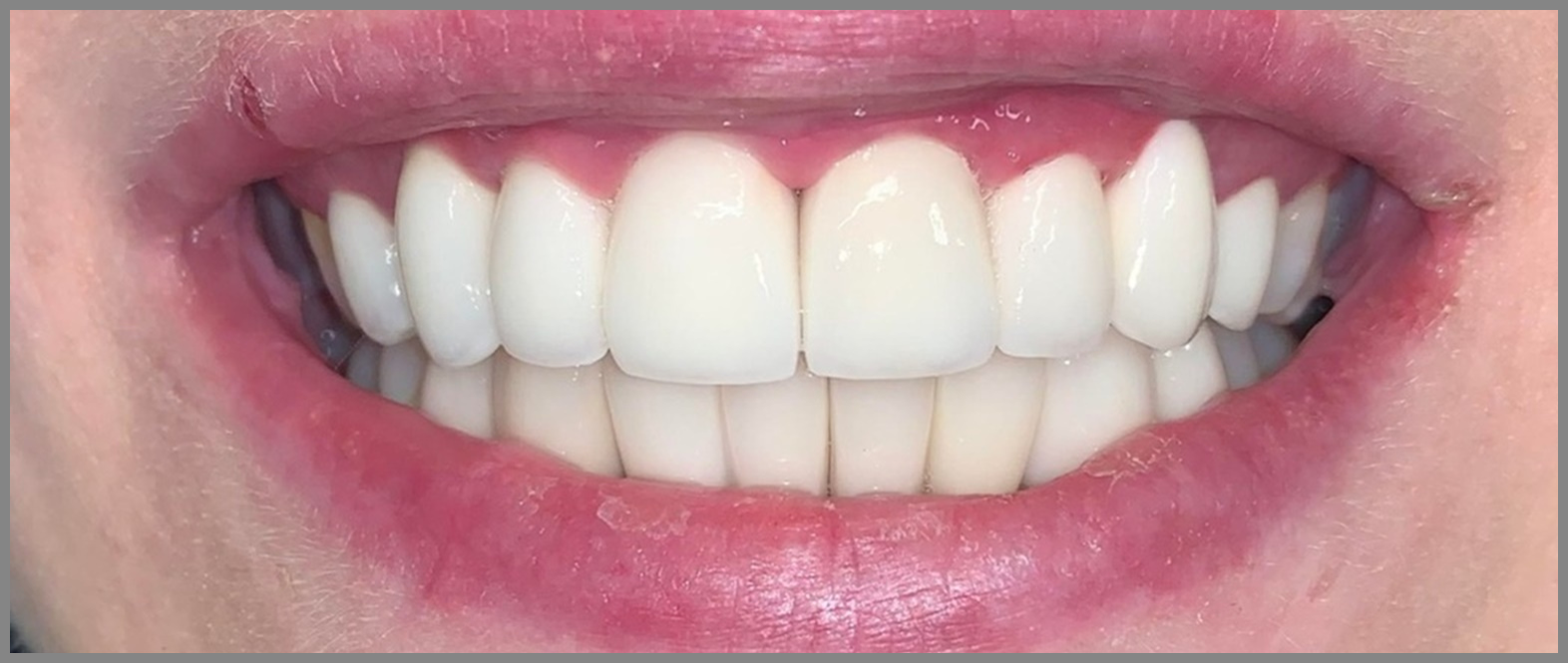 Zähne vor der Zahnbehandlung – Vorher-Bild einer Patientin bei Bavaria Dental Budapest